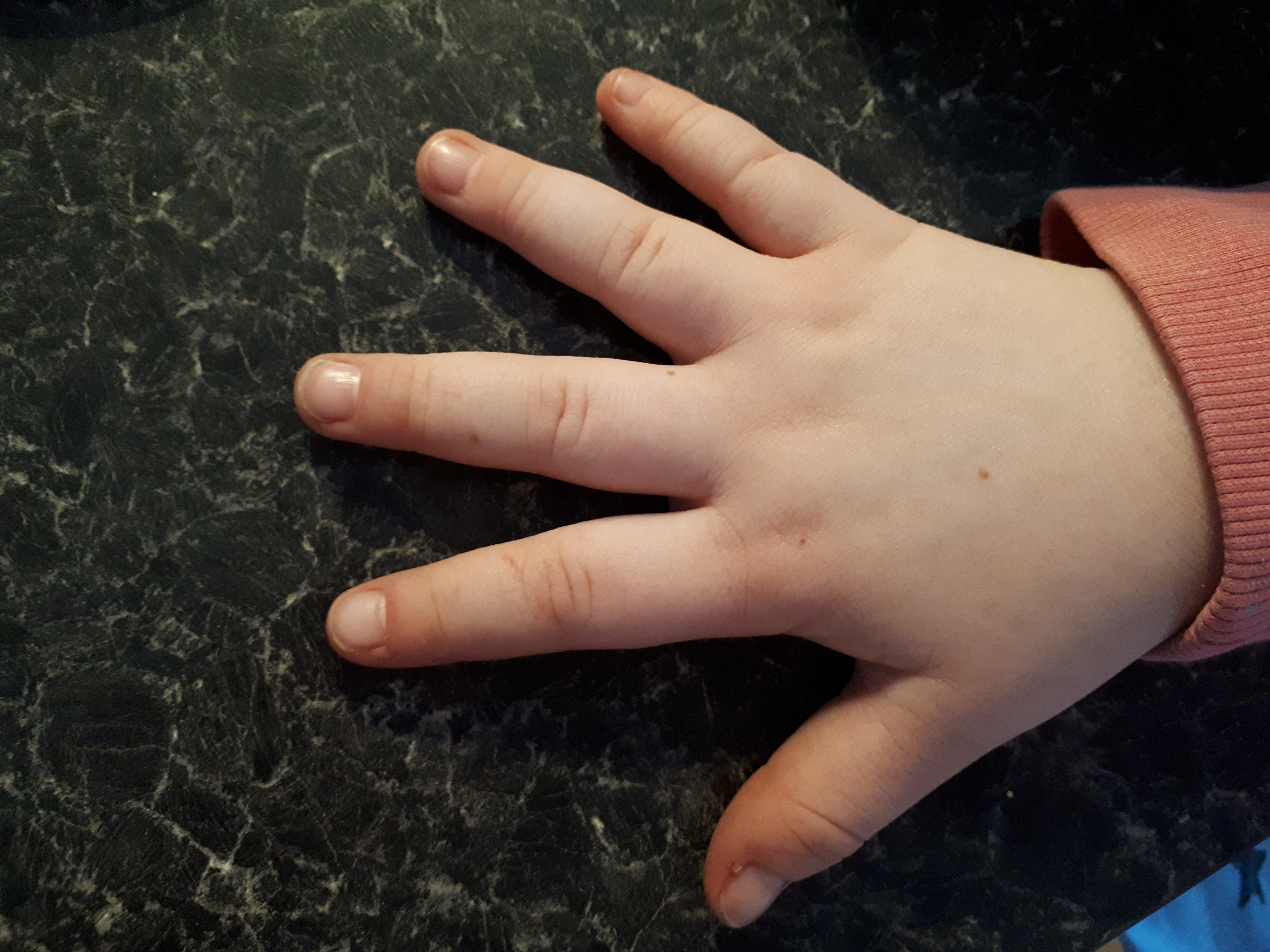 Broad, stubby tapering fingers | Rare Care World